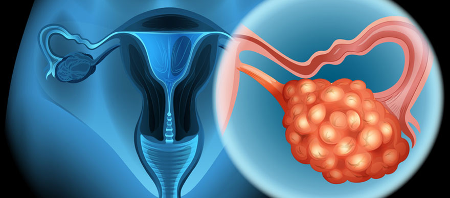 Gyne Oncology
