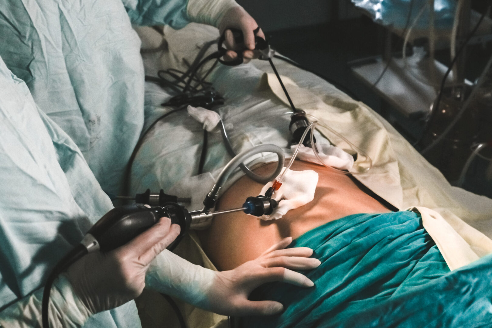 Laproscopic Surgery
